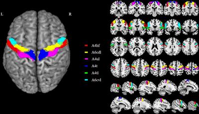 Altered functional connectivity between primary motor cortex subregions and the whole brain in patients with incomplete cervical spinal cord injury